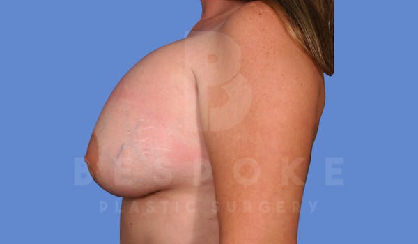 Breast Revision Surgery Before & After Gallery - Patient 144296383 - Image 3