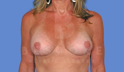 Breast Revision Surgery Before & After Gallery - Patient 144296391 - Image 2