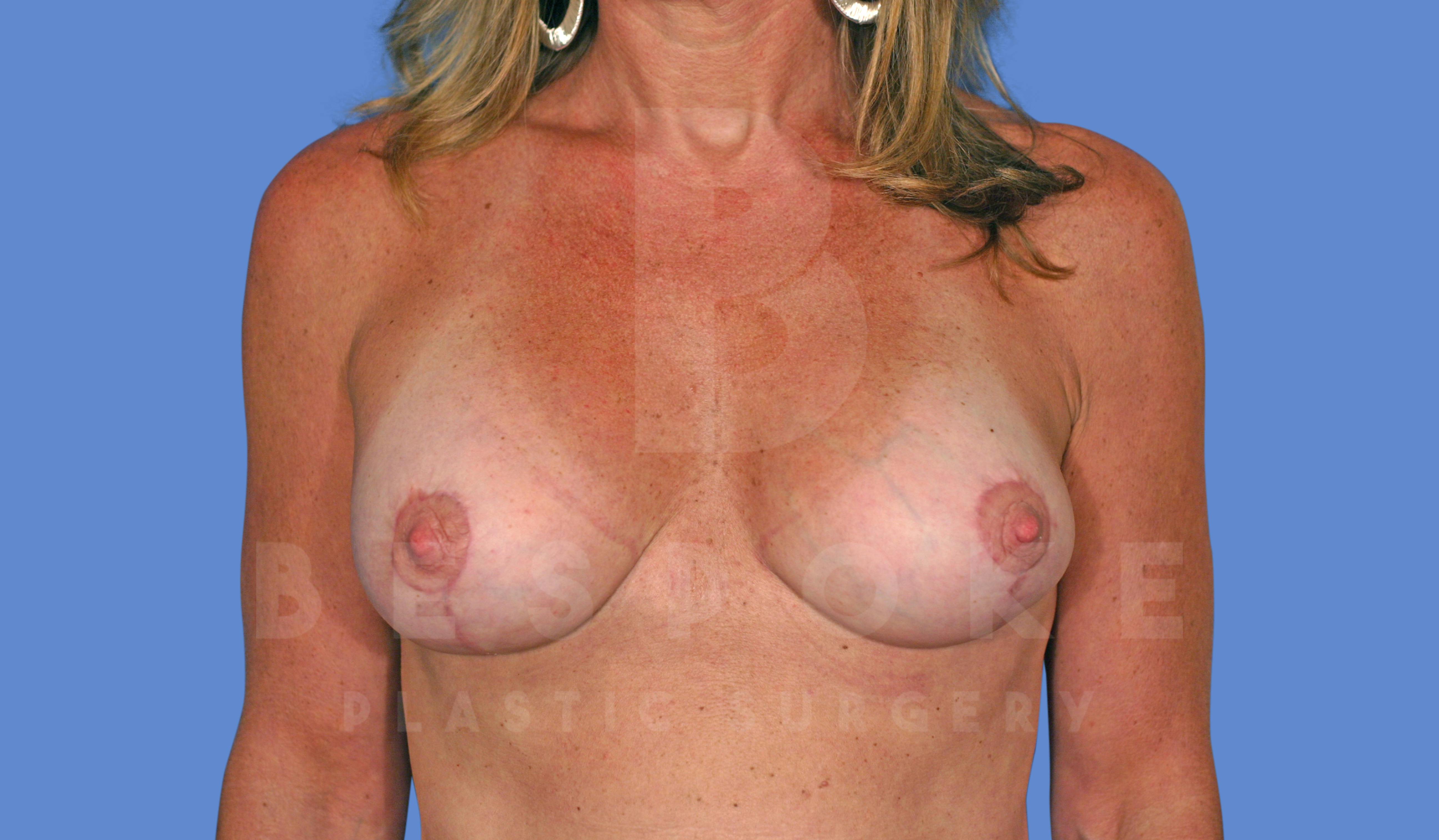 Breast Revision Surgery Before & After Gallery - Patient 144296391 - Image 2