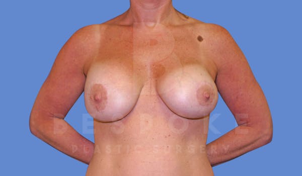 Breast Revision Surgery Before & After Gallery - Patient 144296391 - Image 1