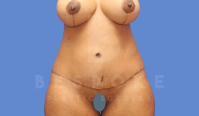 Tummy Tuck Before & After Gallery - Patient 144296401 - Image 2