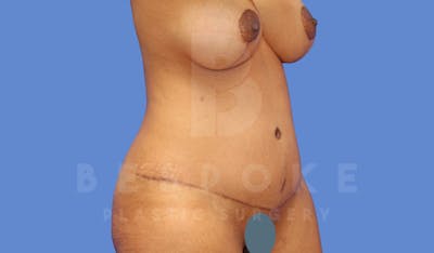 Tummy Tuck Before & After Gallery - Patient 144296401 - Image 4