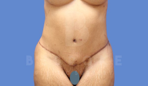 Tummy Tuck Before & After Gallery - Patient 144296400 - Image 2