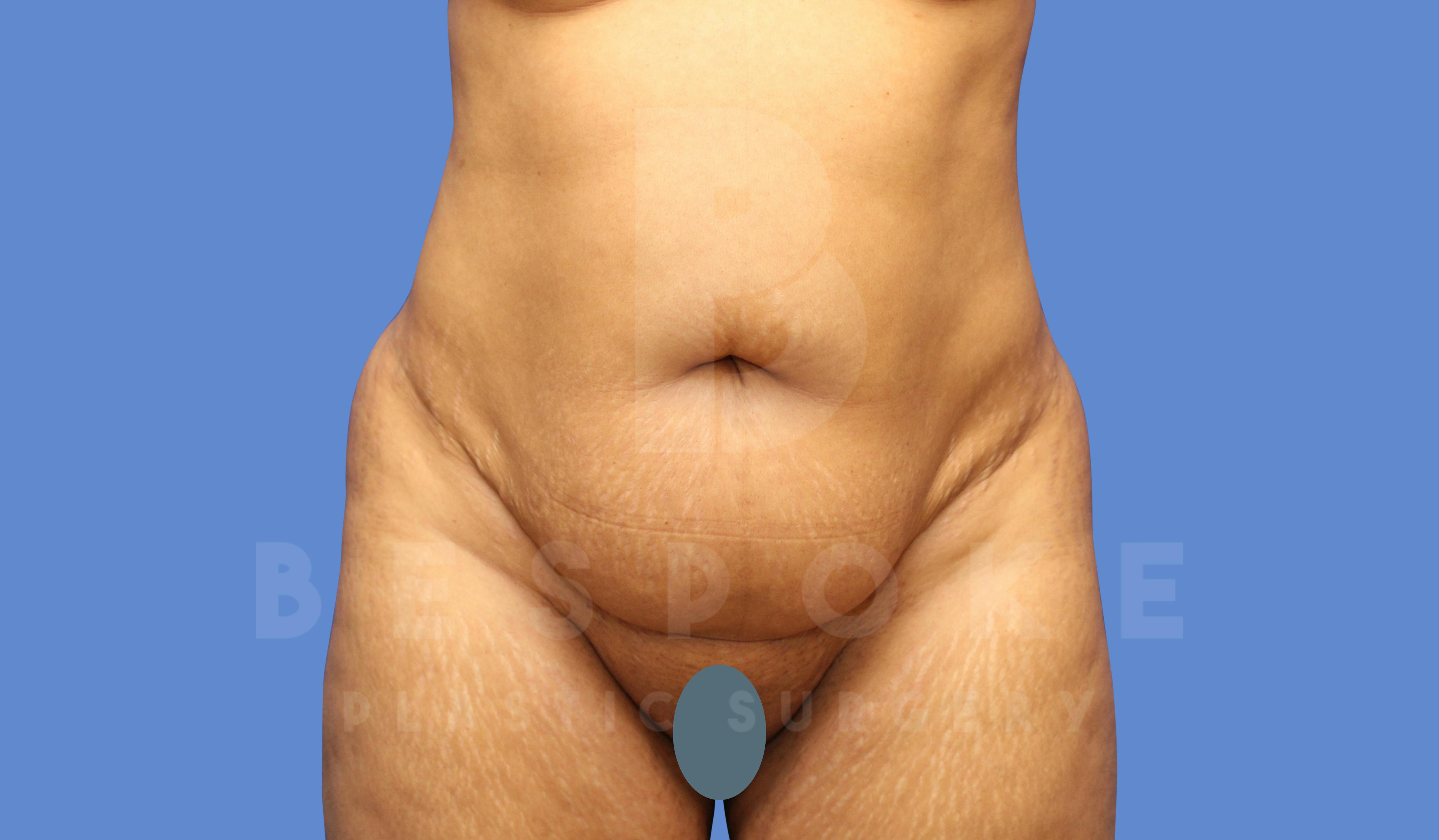 Tummy Tuck Before & After Gallery - Patient 144296400 - Image 1