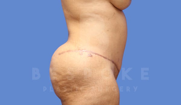 Tummy Tuck Before & After Gallery - Patient 144296400 - Image 4