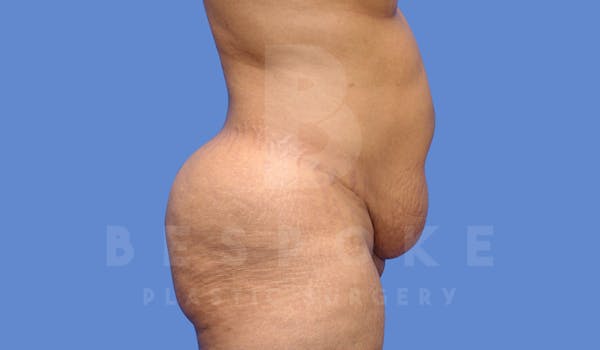 Tummy Tuck Before & After Gallery - Patient 144296400 - Image 3