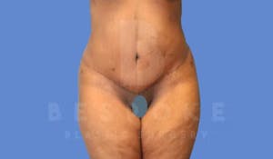 Charlotte NC Before & After Tummy Tuck