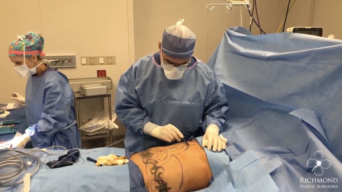 Liposuction surgery