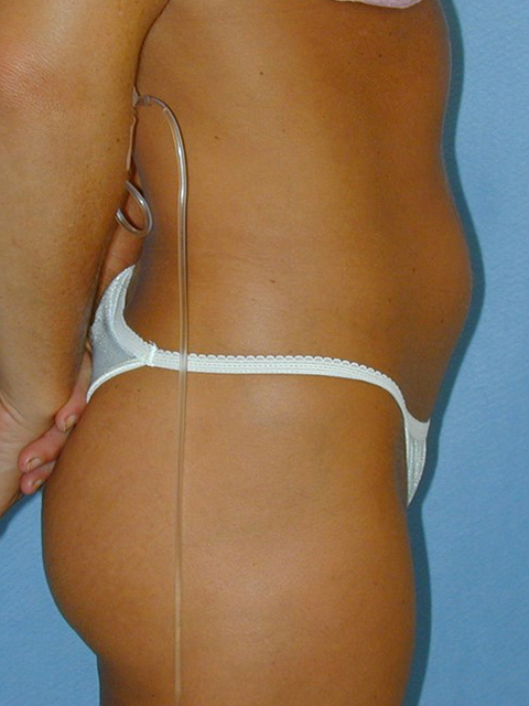 Liposuction Before and After Pictures Richmond, VA