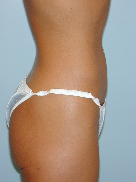 Liposuction Before and After Pictures Richmond, VA