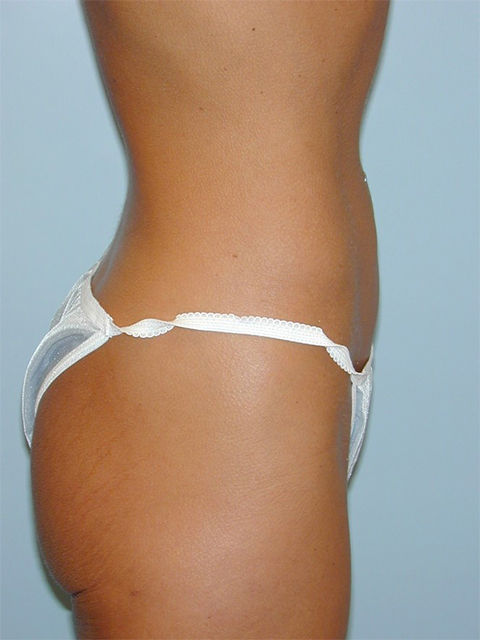 Liposuction Before and After Pictures Richmond, VA