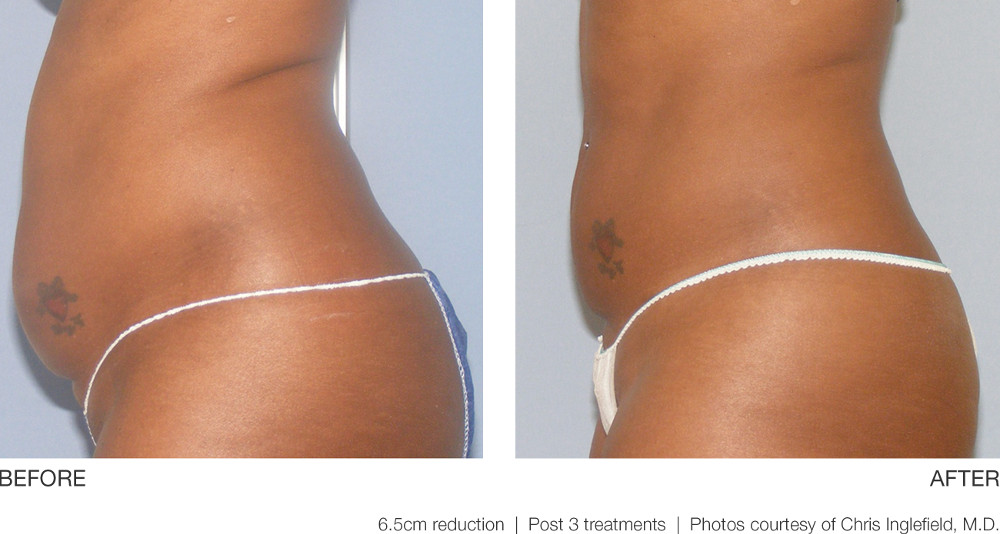 UltraShape® Before and After Pictures Richmond, VA