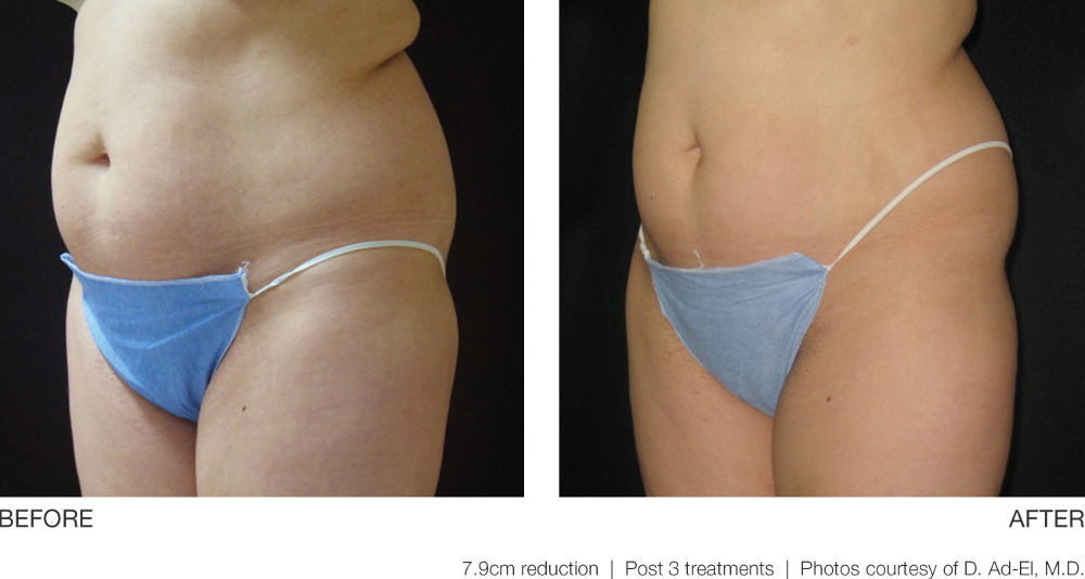 UltraShape® Before and After Pictures Richmond, VA