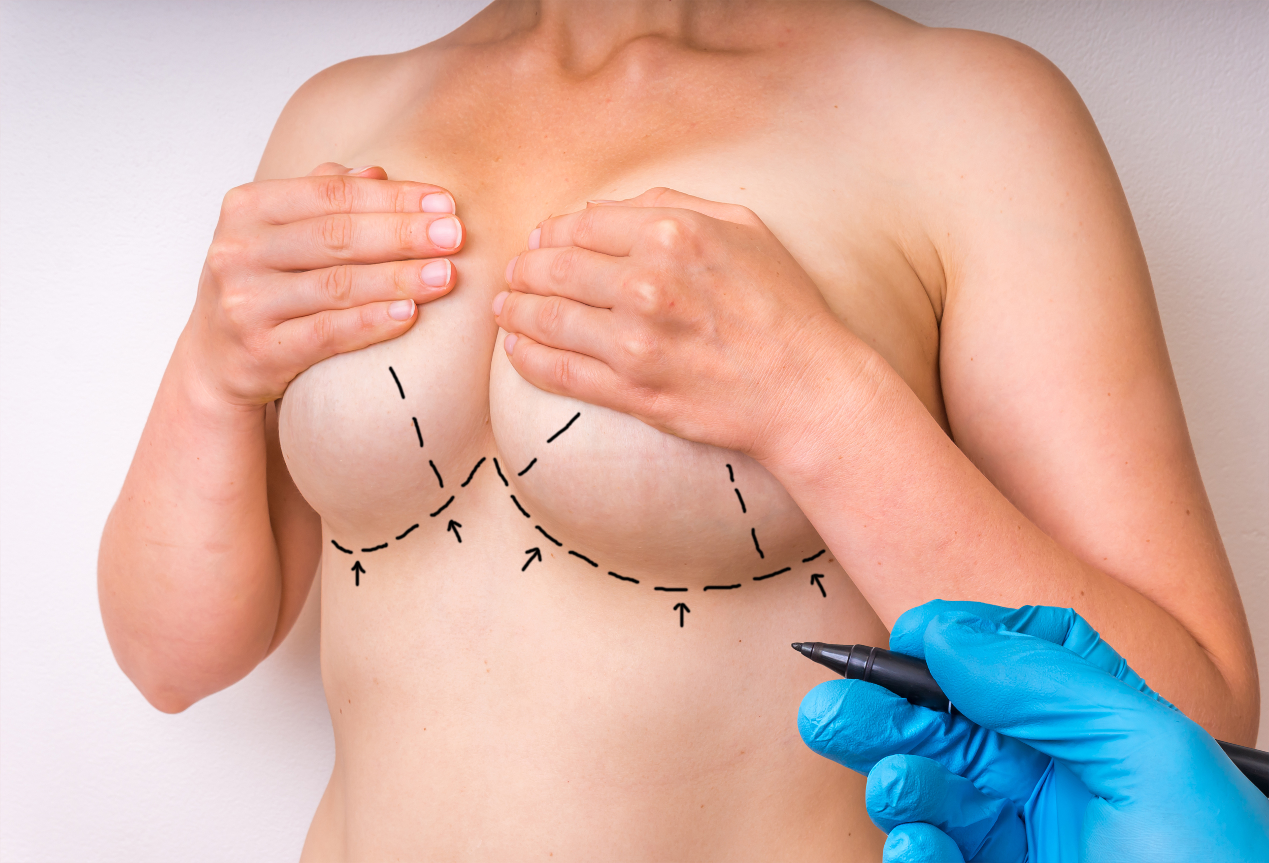 Breast Augmentation with Fat Transfer in Richmond, VA