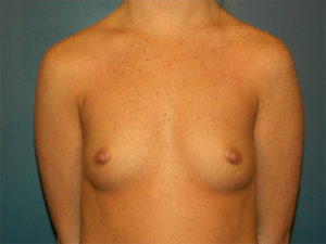 Breast Augmentation