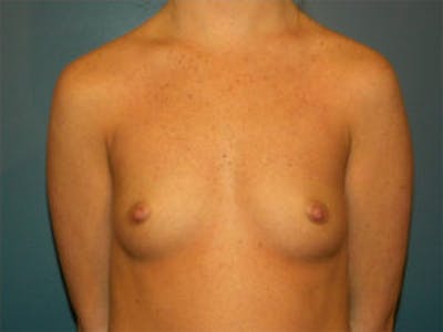 Breast Augmentation Before & After Gallery - Patient 4594784 - Image 1