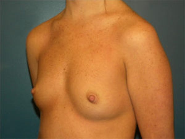 Breast Augmentation Before & After Gallery - Patient 4594784 - Image 3