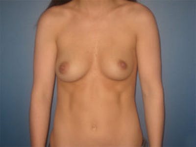 Breast Augmentation Before & After Gallery - Patient 4594785 - Image 1