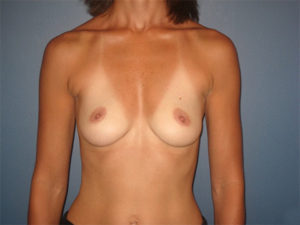 Breast Augmentation