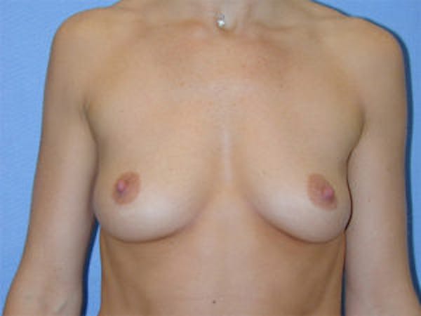 Breast Augmentation Before & After Gallery - Patient 4594798 - Image 1