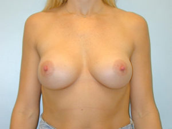 Breast Augmentation Before & After Gallery - Patient 4594798 - Image 2