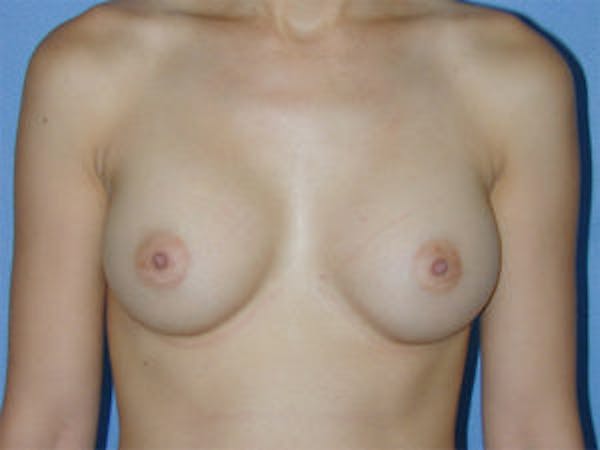 Breast Augmentation Before & After Gallery - Patient 4594800 - Image 2