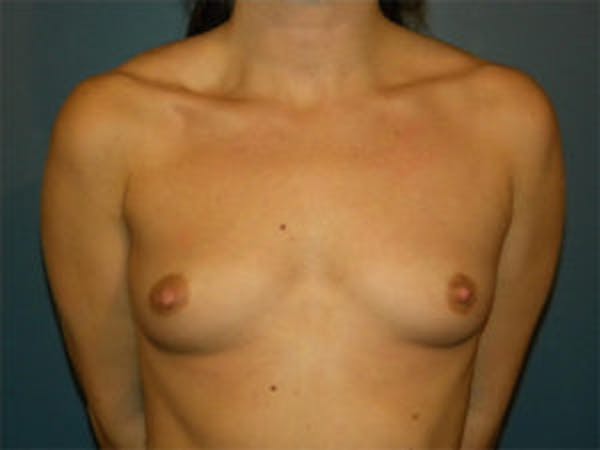 Breast Augmentation Before & After Gallery - Patient 4594802 - Image 1