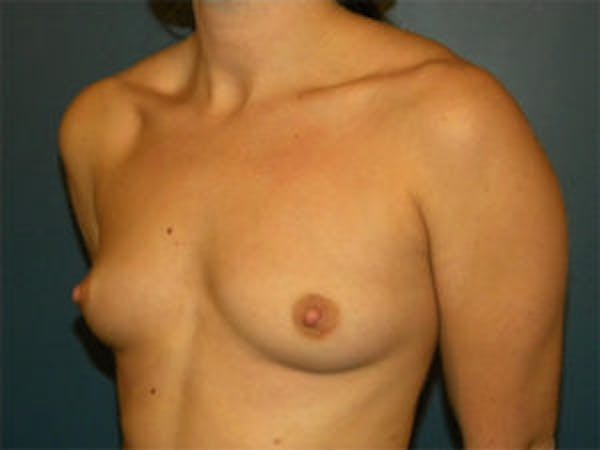 Breast Augmentation Before & After Gallery - Patient 4594802 - Image 3