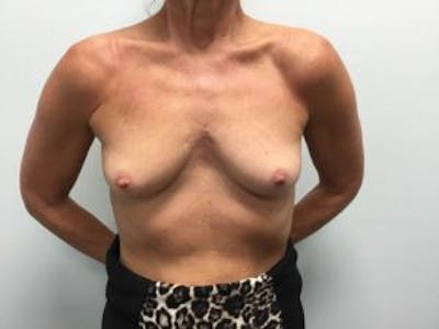 Breast Augmentation Before & After Gallery - Patient 4594803 - Image 1