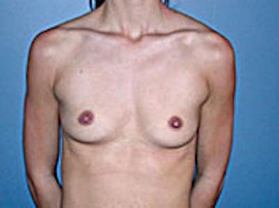 Breast Augmentation Gallery - Patient 4594804 - Image 1