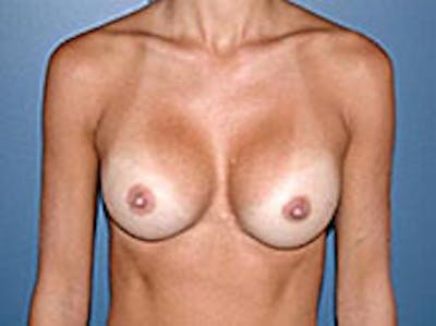 Breast Augmentation Before & After Gallery - Patient 4594804 - Image 2