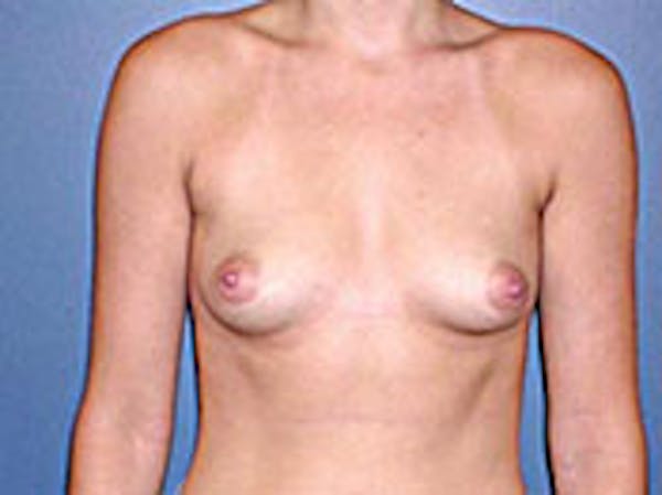 Breast Augmentation Gallery - Patient 4594805 - Image 1