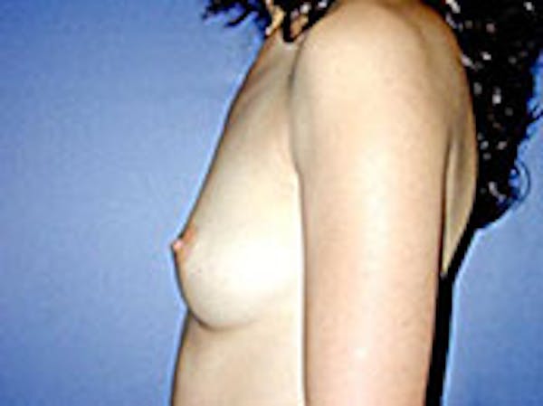 Breast Augmentation Before & After Gallery - Patient 4594800 - Image 5