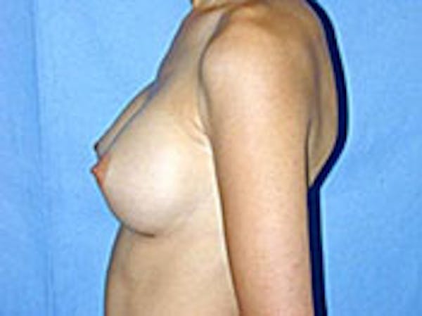 Breast Augmentation Before & After Gallery - Patient 4594800 - Image 6