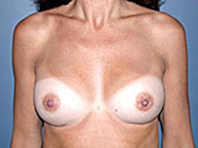 Breast Augmentation Before & After Gallery - Patient 4594808 - Image 2