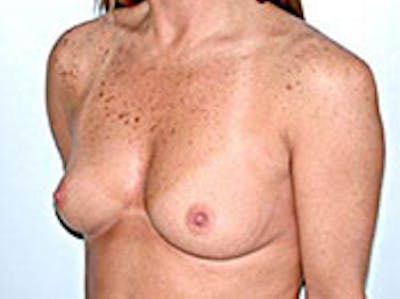 Breast Augmentation Before & After Gallery - Patient 4594809 - Image 1