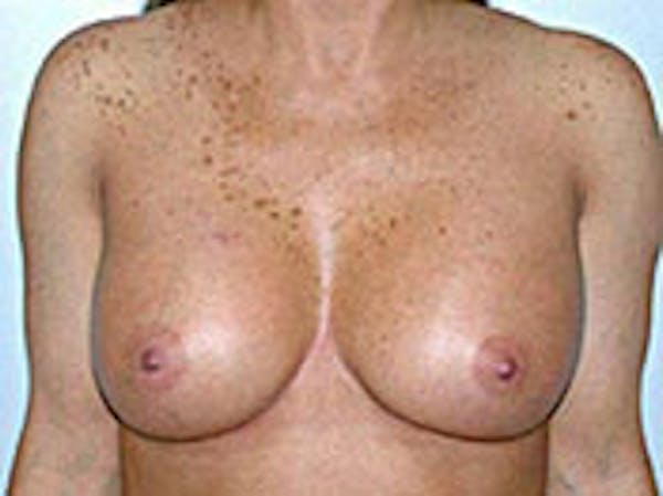 Breast Augmentation Before & After Gallery - Patient 4594809 - Image 2