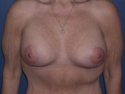 Breast Augmentation Before & After Gallery - Patient 4594810 - Image 2