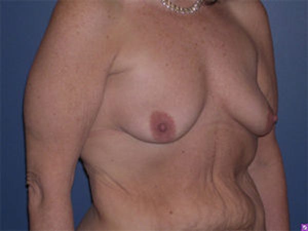 Breast Augmentation Before & After Gallery - Patient 4594810 - Image 3