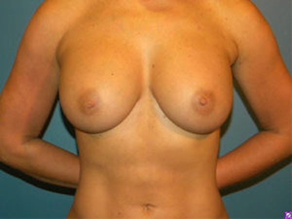 Breast Augmentation Before & After Gallery - Patient 4594812 - Image 2