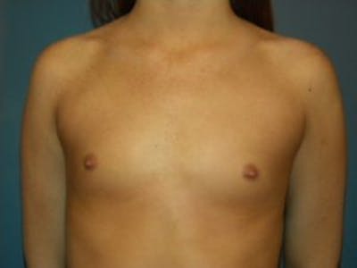 Breast Augmentation Before & After Gallery - Patient 4594813 - Image 1