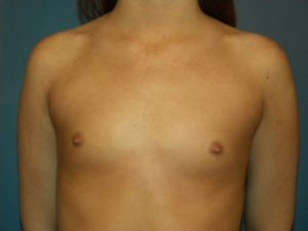 Breast Augmentation Before & After Gallery - Patient 4594813 - Image 1