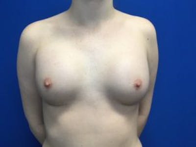 Breast Augmentation Before & After Gallery - Patient 4594813 - Image 2