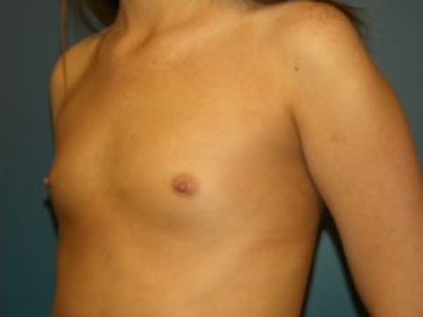 Breast Augmentation Before & After Gallery - Patient 4594813 - Image 3