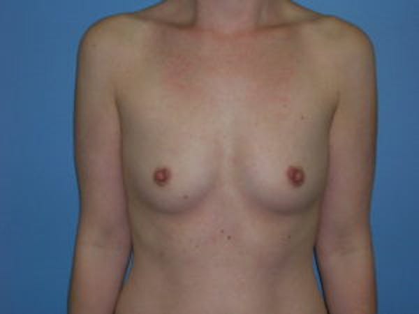Breast Augmentation Before & After Gallery - Patient 4594814 - Image 1