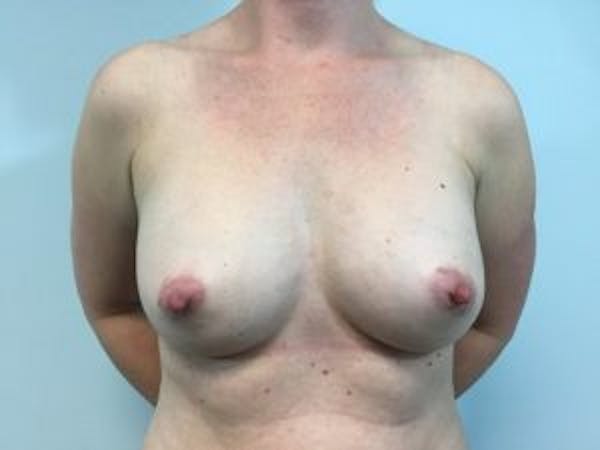 Breast Augmentation Gallery - Patient 4594814 - Image 2