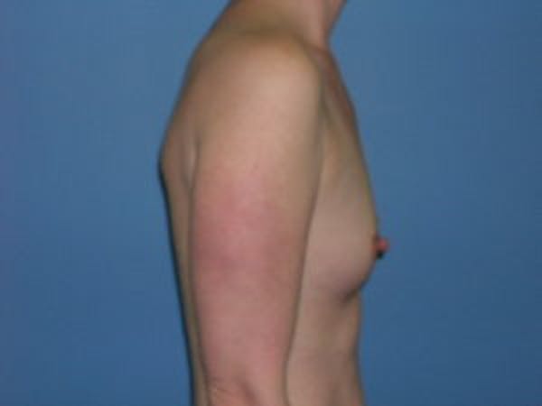 Breast Augmentation Before & After Gallery - Patient 4594814 - Image 3