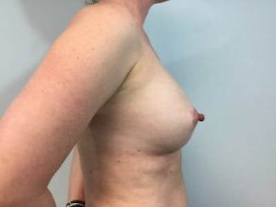 Breast Augmentation Before & After Gallery - Patient 4594814 - Image 4