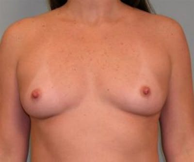Breast Augmentation Before & After Gallery - Patient 4594816 - Image 1