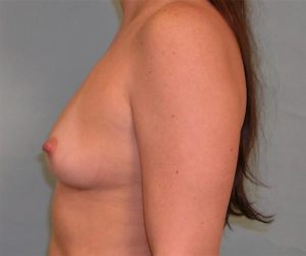Breast Augmentation Before & After Gallery - Patient 4594816 - Image 3